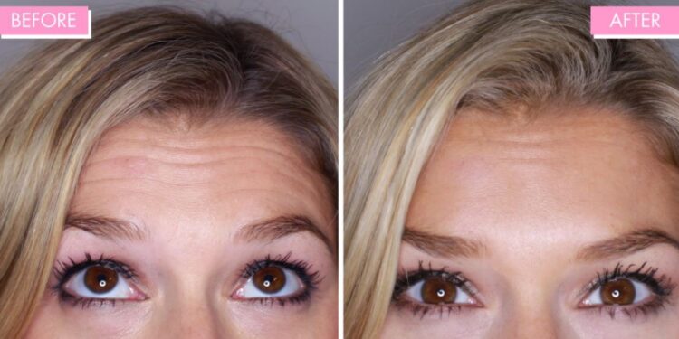 СЭРЭМЖЛҮҮЛЭГ: ЭМЭГТЭЙЧҮҮДЭЭ “БОТТОКС” ҮХЛИЙН ХОР ШҮҮ!!!