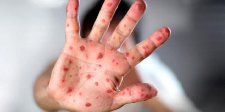 Монголчуудын их зорчдог Азийн орнуудад улаанбурхан өвчний тохиолдол бүртгэгдэж байна